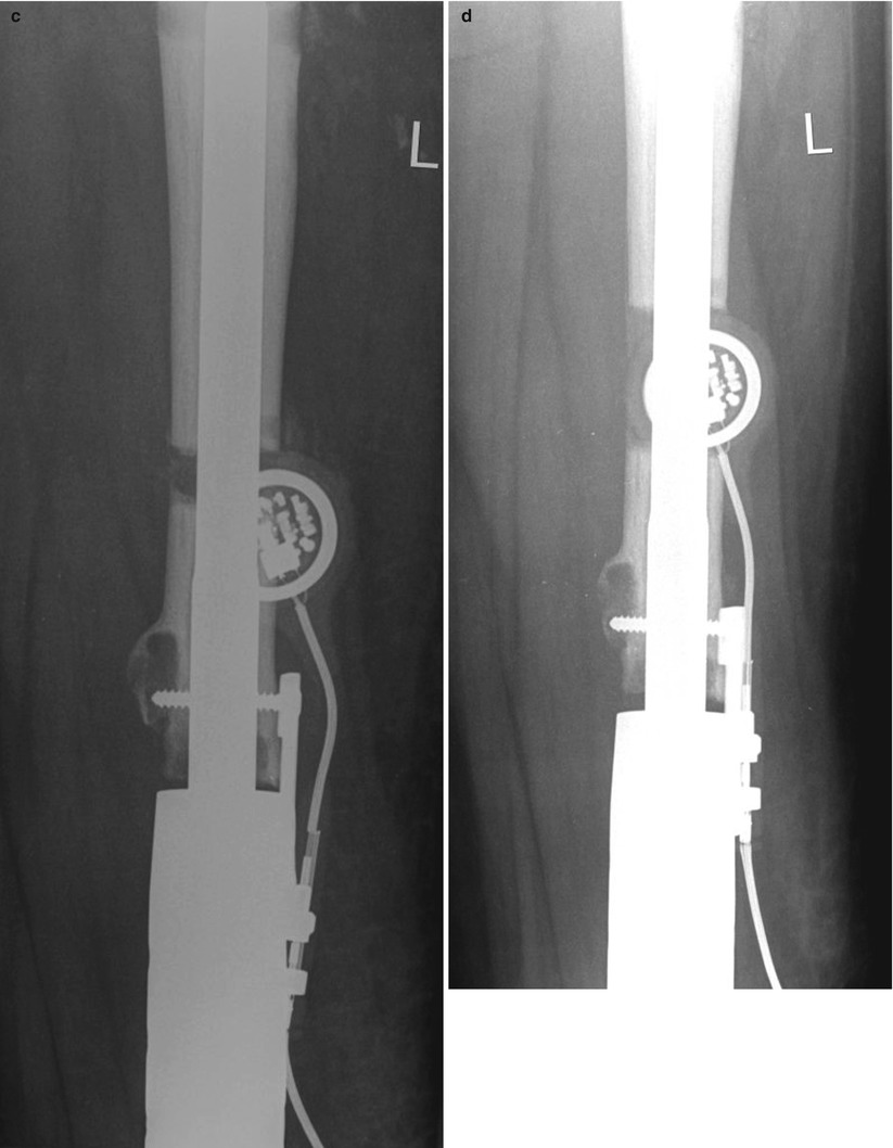 Limb Lengthening: Computerized | Musculoskeletal Key