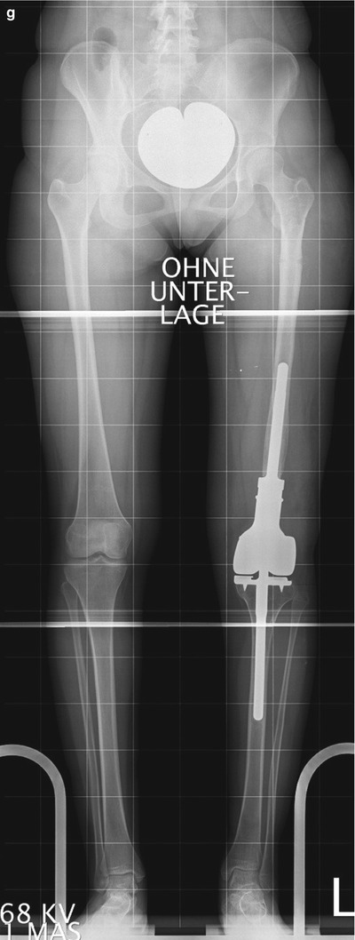 Limb Lengthening: Computerized | Musculoskeletal Key