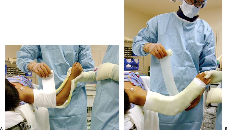 Cast And Splint Immobilization, Remodeling And Special Issues Of ...