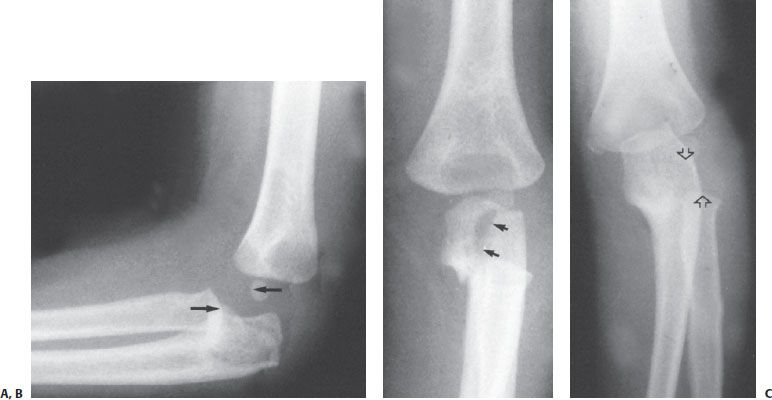 Monteggia Fracture-Dislocation In Children | Musculoskeletal Key