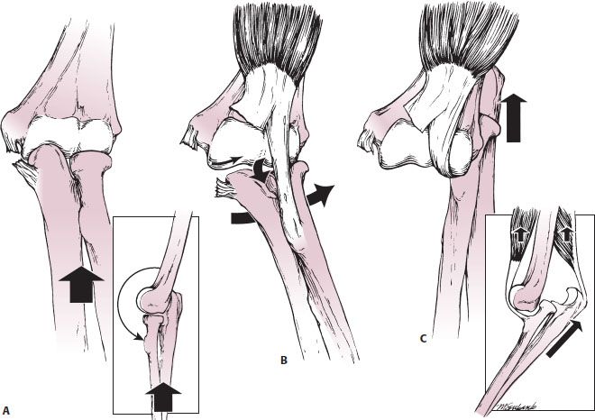 Dislocations Of The Elbows, Medial Epicondylar Humerus Fractures ...