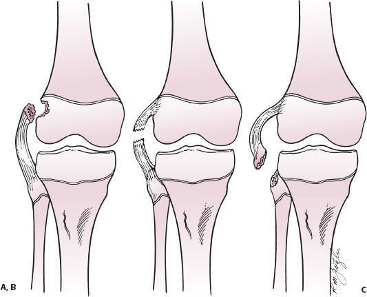 Intra-Articular Injuries Of The Knee | Musculoskeletal Key