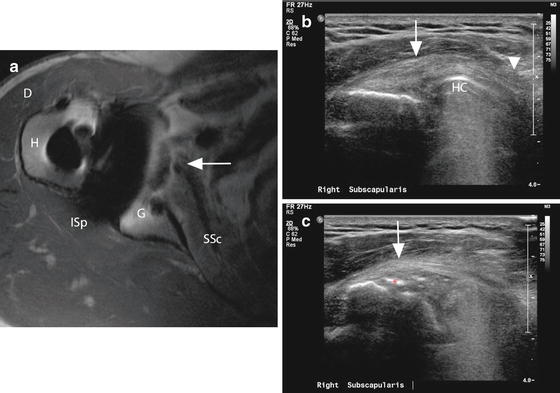 Imaging Of The Rotator Cuff | Musculoskeletal Key