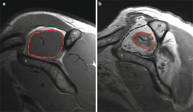 Imaging Of The Rotator Cuff | Musculoskeletal Key