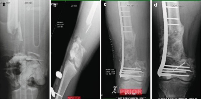 Amputation Versus Limb Salvage Of The Lower Extremity | Musculoskeletal Key