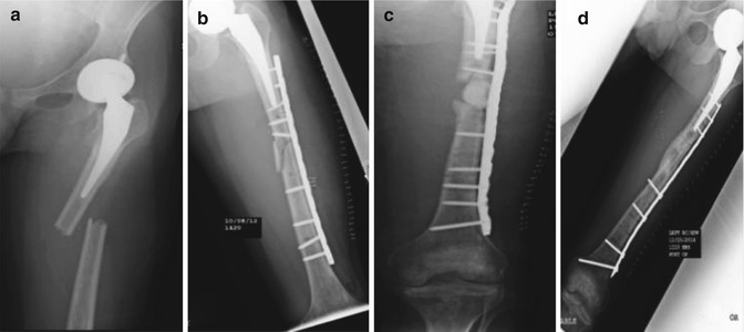 Amputation Versus Limb Salvage Of The Lower Extremity | Musculoskeletal Key