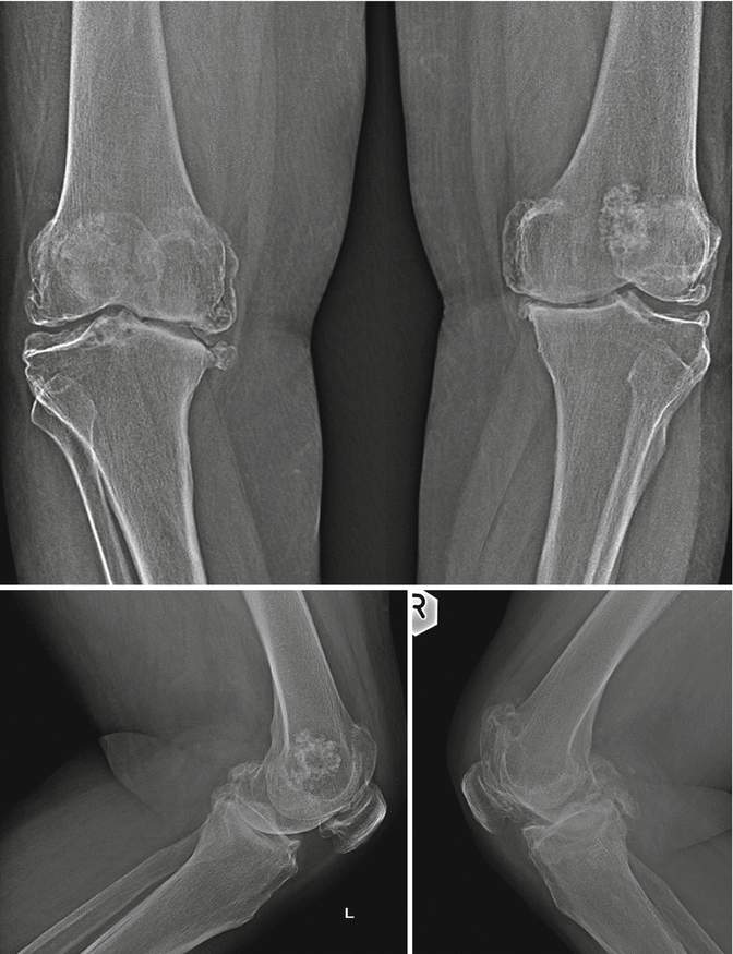 Osteoarthritis | Musculoskeletal Key