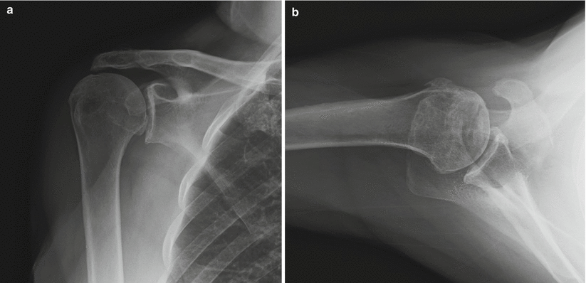 Shoulder Arthroplasty: Evolution In Design, Indications, Surgical ...