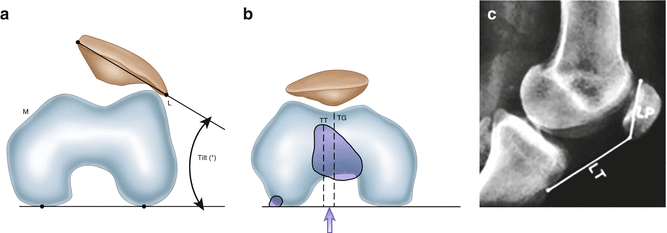 Patellofemoral Pain And Instability | Musculoskeletal Key