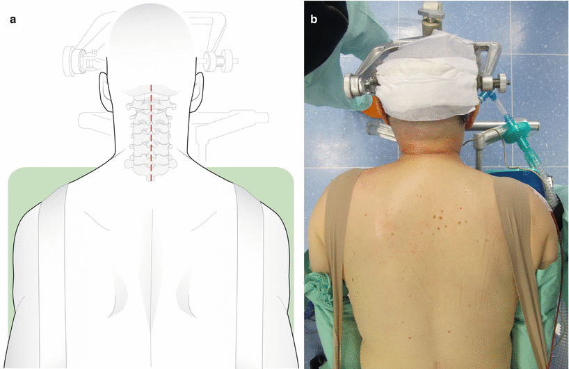 Posterior Approach To Cervical Spine | Musculoskeletal Key