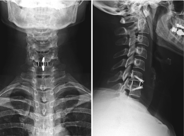 Exemplificative Cases In Cervical Spine | Musculoskeletal Key