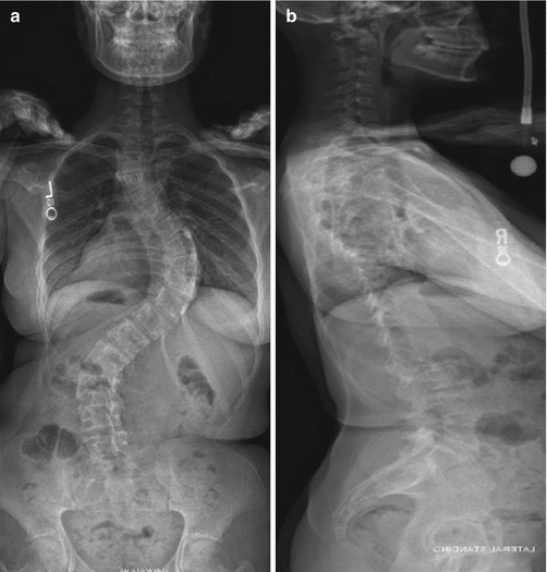 Defining Adult Lumbar Scoliosis | Musculoskeletal Key