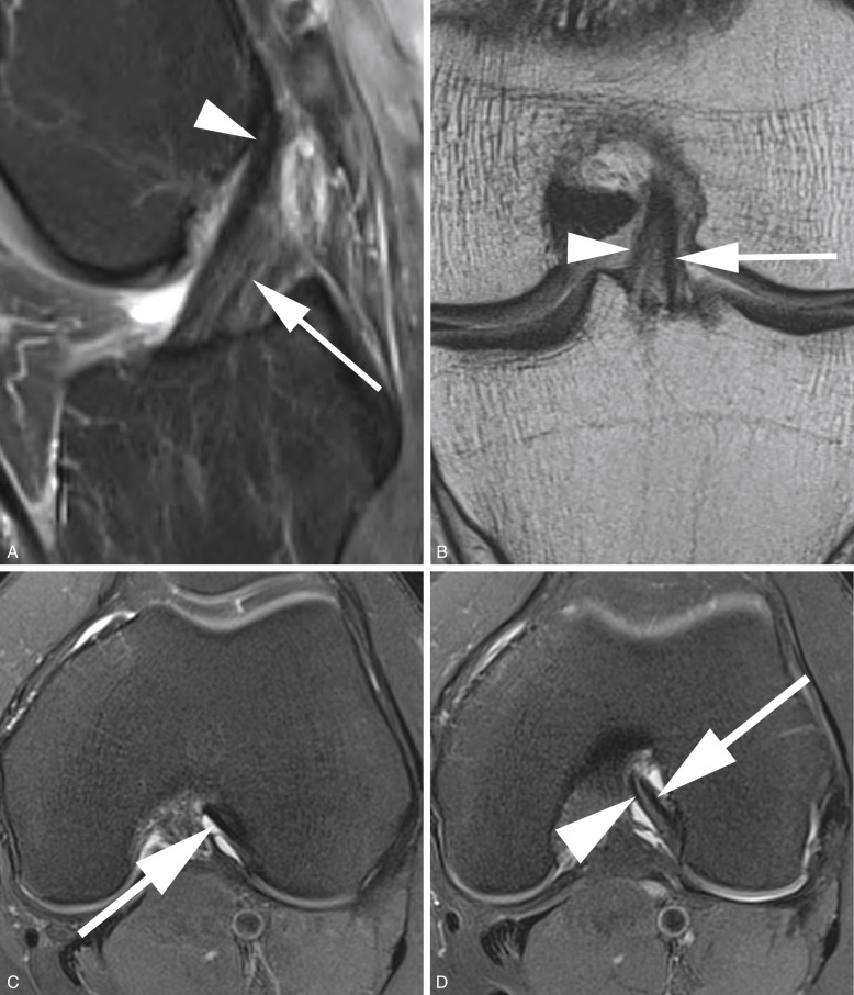 Magnetic Resonance Imaging For The Diagnosis And Treatment Of Anterior ...