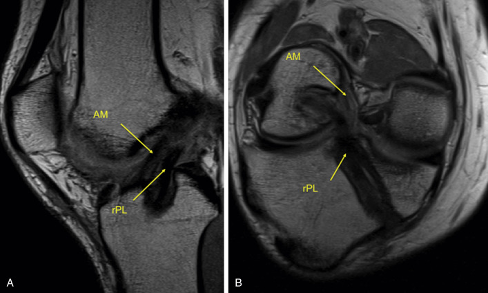 Criteria For Return To Play After Anterior Cruciate Ligament ...