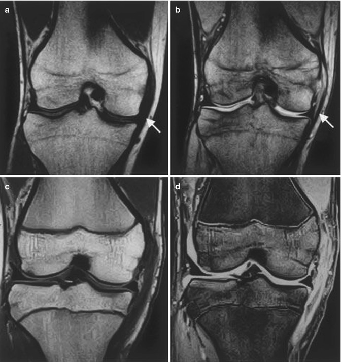 Treatment Of MCL Injury In Combined ACL/MCL Injury | Musculoskeletal Key