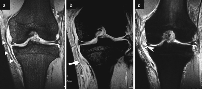 Treatment Of MCL Injury In Combined ACL/MCL Injury | Musculoskeletal Key