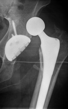 Dislocation After Total Hip Arthroplasty | Musculoskeletal Key