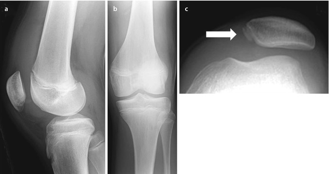 A 13-Year-Old Boy | Musculoskeletal Key