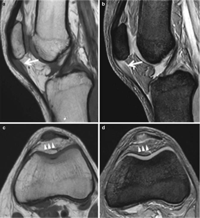 Pathogenesis And Treatment Of Patellar Tendinopathy | Musculoskeletal Key