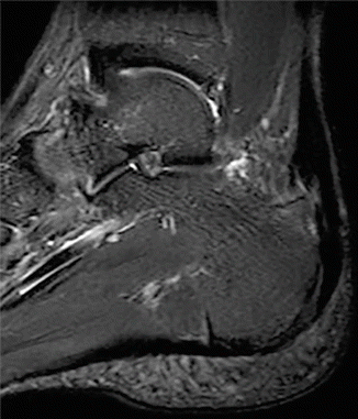 Achilles Tendinopathy | Musculoskeletal Key