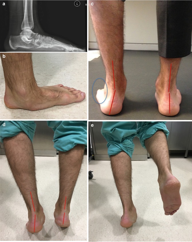 Tibialis Posterior And Anterior Tendons | Musculoskeletal Key