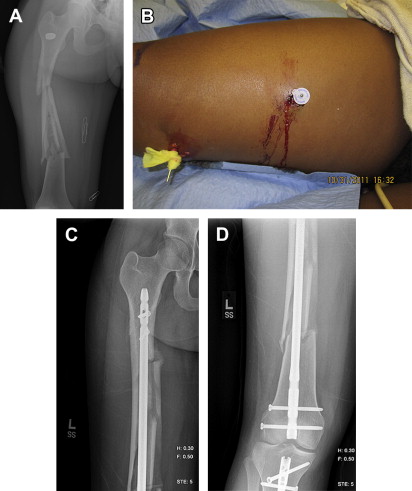 Surgical Management Principles Of Gunshot-Related Fractures ...