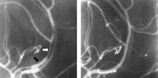 Primary Angiitis Of The Central Nervous System: Differential Diagnosis ...