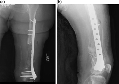 Femoral Shaft Nonunions | Musculoskeletal Key