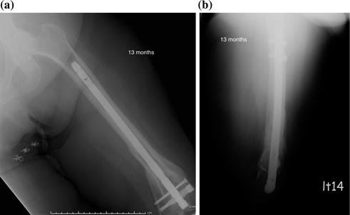 Distal Femoral Nonunions | Musculoskeletal Key