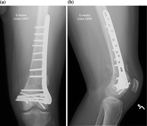 Distal Femoral Nonunions | Musculoskeletal Key