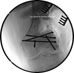 Distal Femoral Nonunions | Musculoskeletal Key