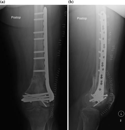 Distal Femoral Nonunions | Musculoskeletal Key