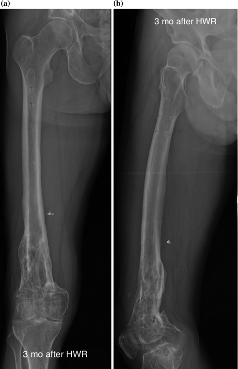 Distal Femoral Nonunions | Musculoskeletal Key