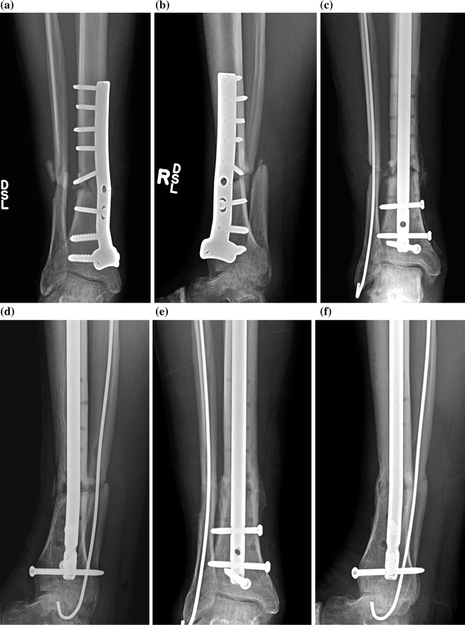 Fracture Healing | Musculoskeletal Key