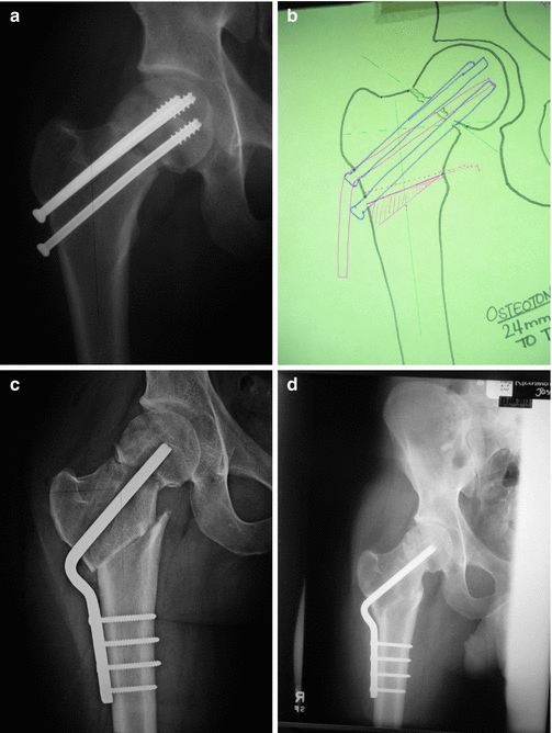 Nonunions Of The Proximal Femur | Musculoskeletal Key