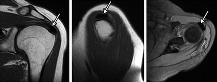 Arthroscopic Management Of Rotator Cuff Calcific Tendonitis ...