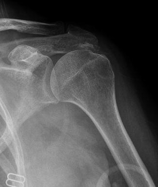 Arthroscopic Management Of Rotator Cuff Calcific Tendonitis ...