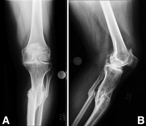 Total Knee Arthroplasty After Fractures About The Knee ...