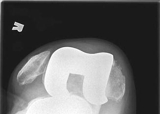 Imaging Of Total Knee Arthroplasty | Musculoskeletal Key