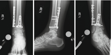 Trimalleolar Ankle Fracture: Posterior Plate For Posterior Malleolus ...