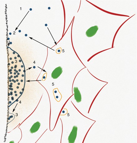 Epidemiology Of Prosthetic Joint Infection | Musculoskeletal Key