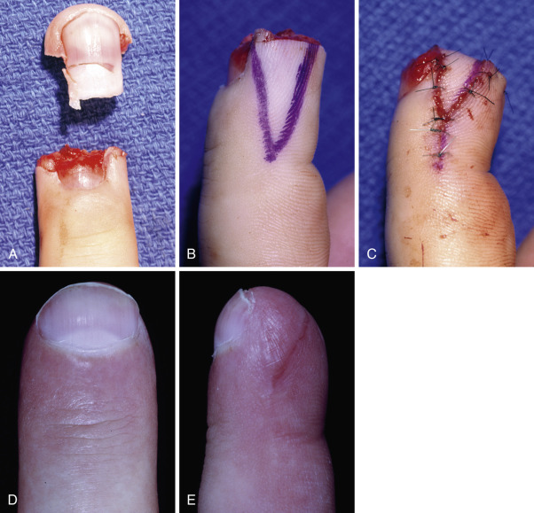 Perionychium | Musculoskeletal Key