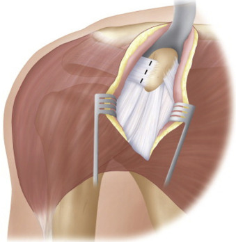 Anterior Shoulder Instability | Musculoskeletal Key