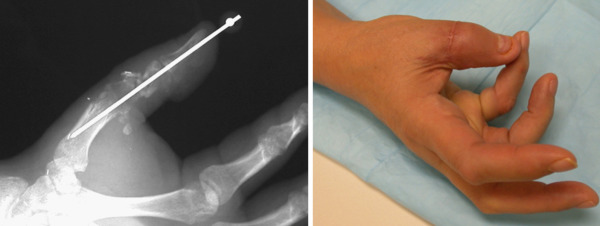 Replantation | Musculoskeletal Key