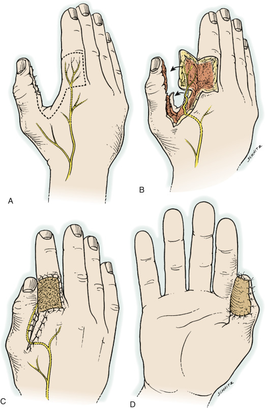 Thumb Reconstruction | Musculoskeletal Key