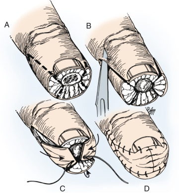 Digital Amputations | Musculoskeletal Key