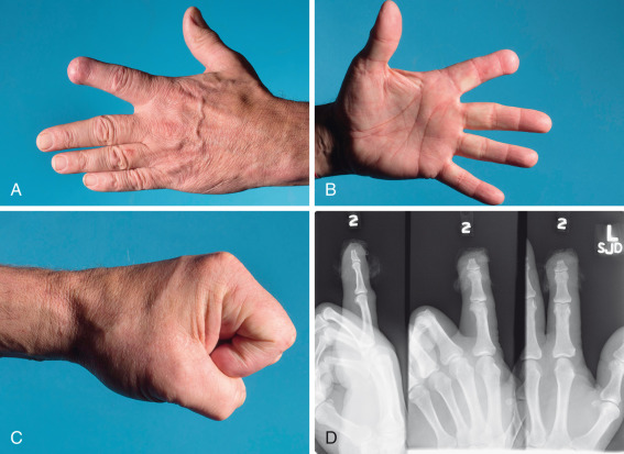 Digital Amputations | Musculoskeletal Key