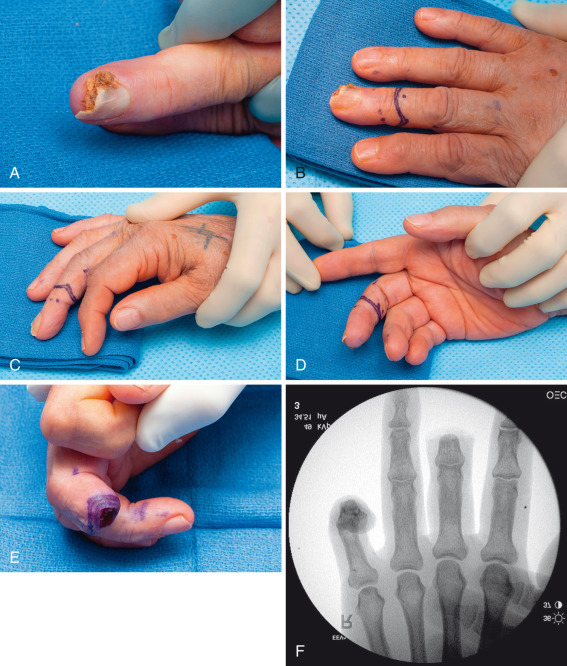 Digital Amputations | Musculoskeletal Key