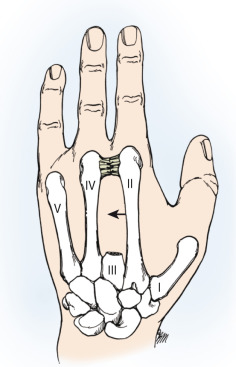 Digital Amputations | Musculoskeletal Key