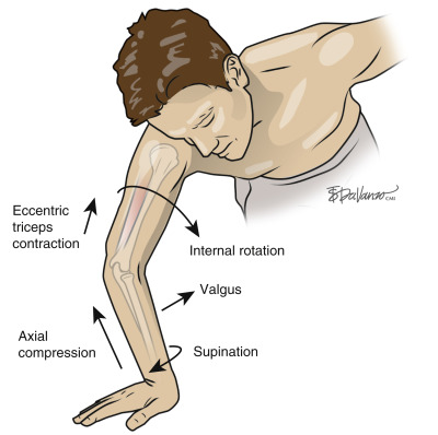 Lateral: Posterolateral Rotary Instability | Musculoskeletal Key